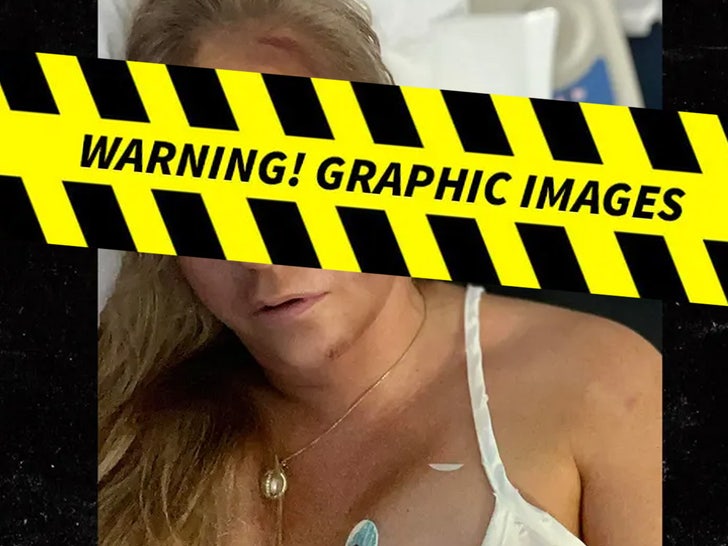 Virginia Giuffre Car Crash Injury