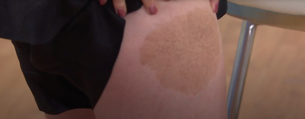 Jenna Bush Hager birthmark today show
