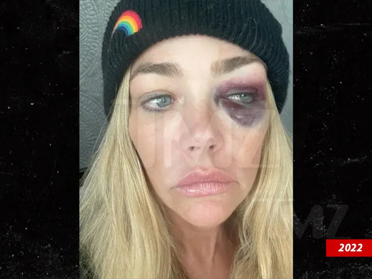 Denise Richards with black eye 2022 2