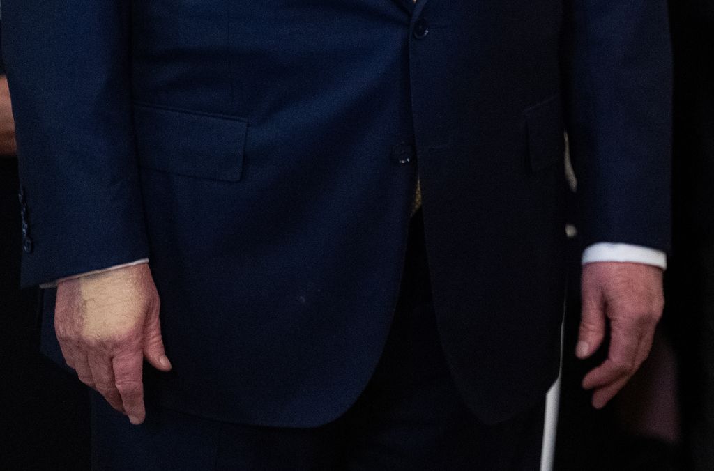 donald trump bruise on hand
