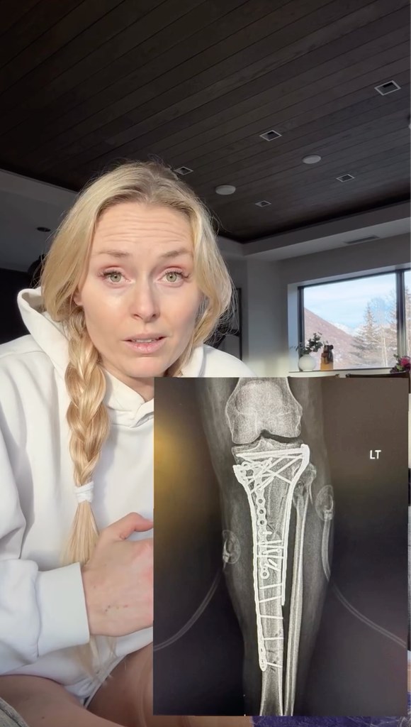 Lindsey vonn leg xray