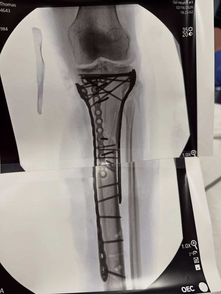 Lindsey Vonn shares a photo of an X-ray scan of her fractured tibia following surgery, shared on Instagram