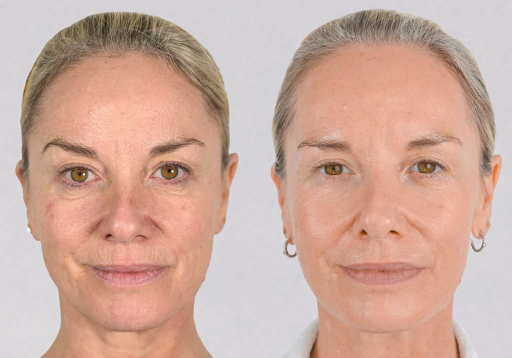 Tamzin Outhwaite Before and After NeoGen facelift