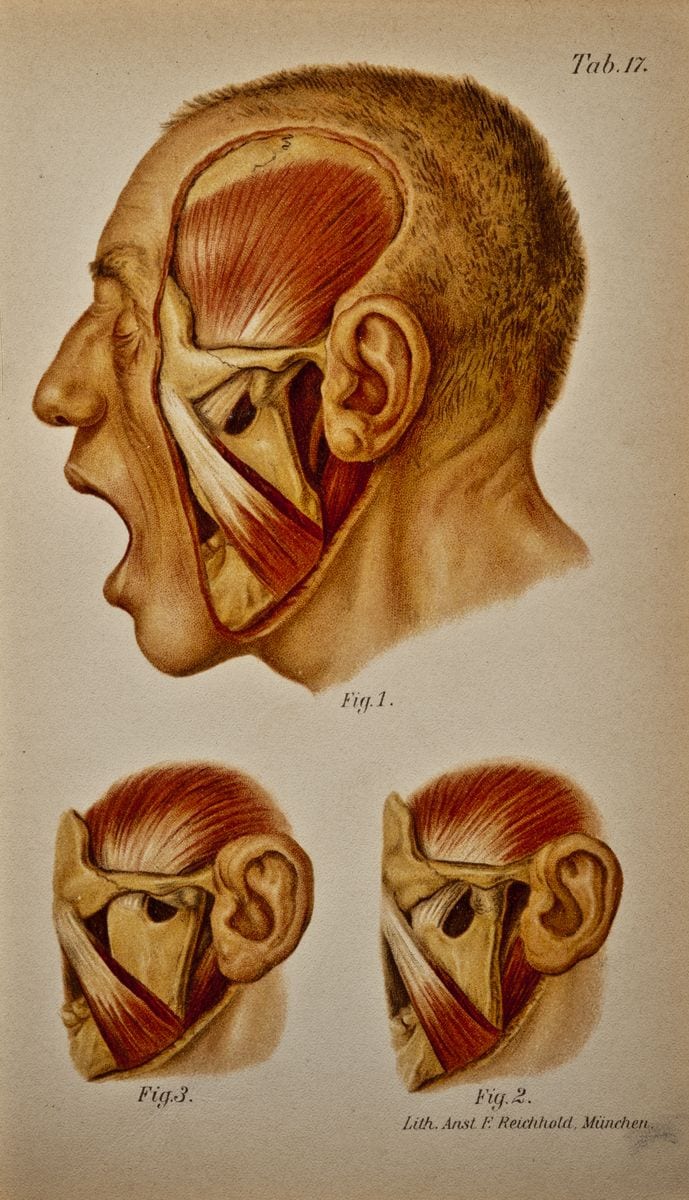 The temporal muscle is in extreme tension as there is a marked dislocation forward of its point of insertion the coronoid process.