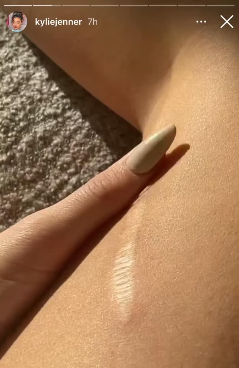 Kylie Jenner has been open about a childhood accident that left her with a permanent scar of about five inches on her left thigh, a mark she now embraces fully.