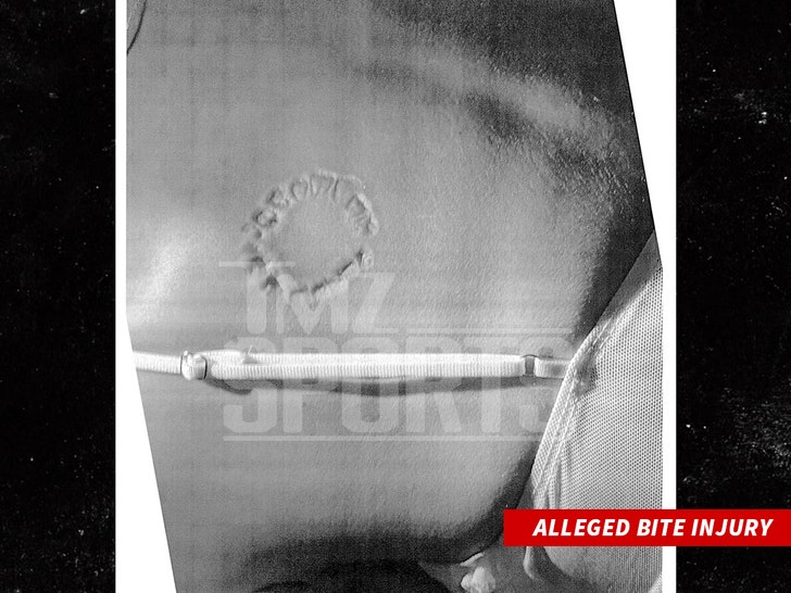 Alleged Bite Injury tmzsports 1