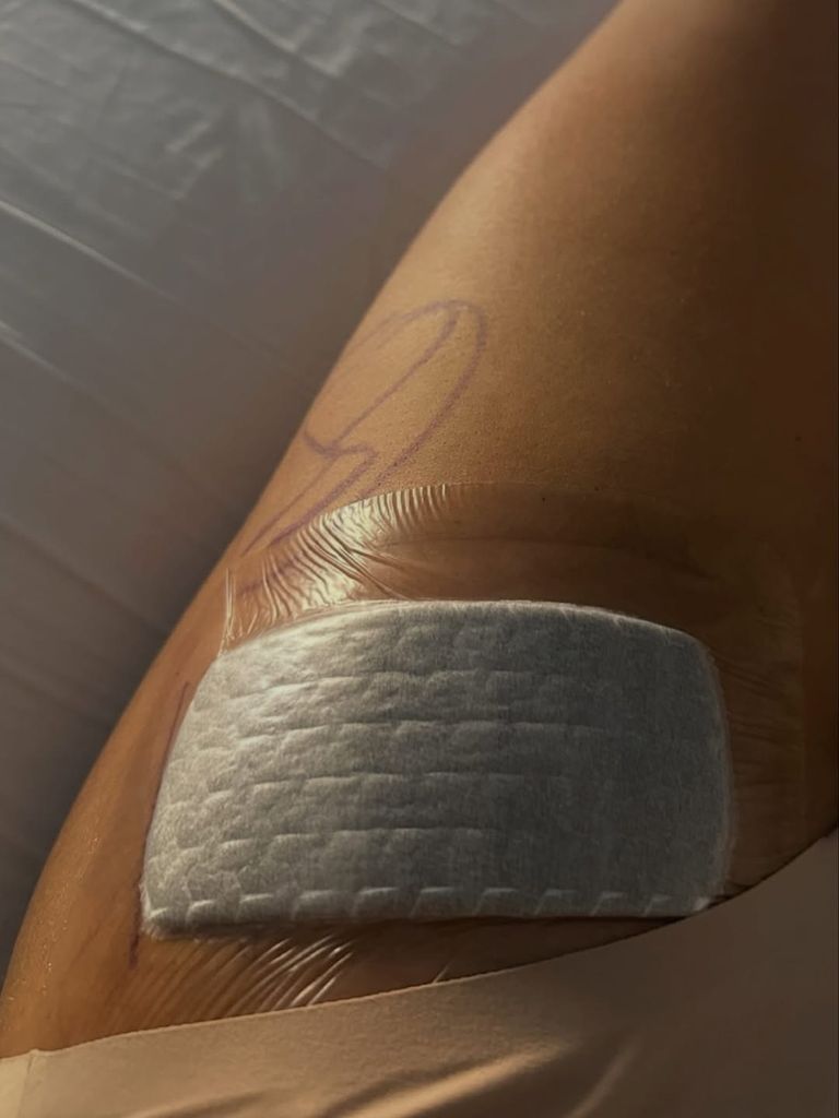 She underwent a hip replacement surgery