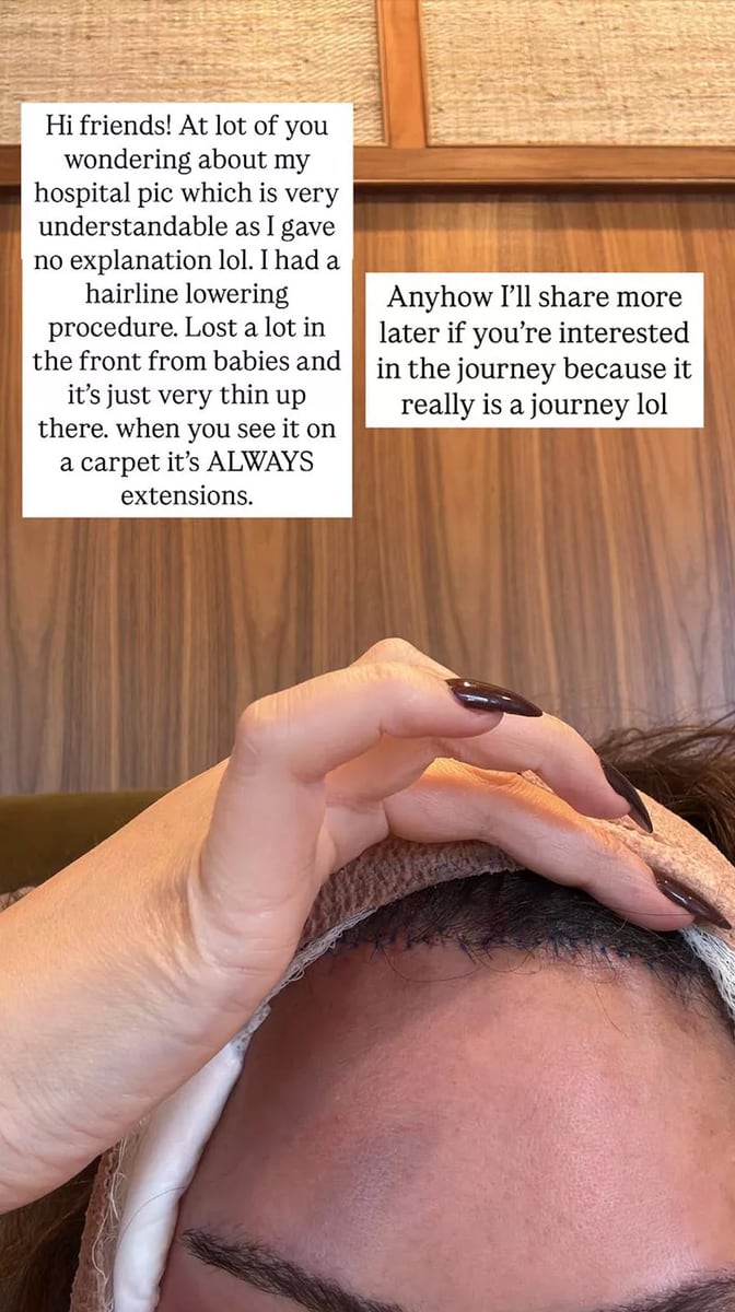 Chrissy had hair-line surgery almost a year ago