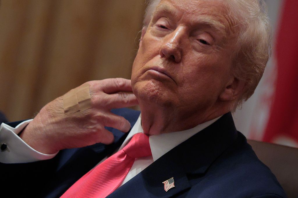 President Donald Trump wears adhesive bandages on the back of his hand during a meeting of his cabinet in the Cabinet Room of the White House on December 02, 2025 in Washington, DC