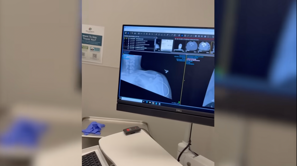 jelly roll broken collarbone