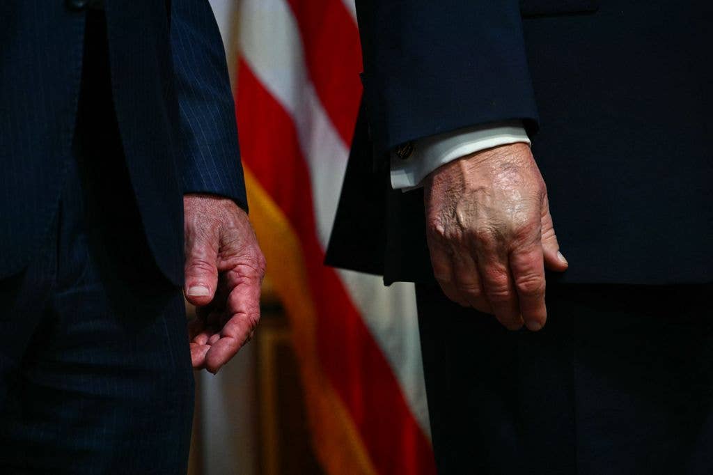 Bruising on Donald Trump's hands has also caused concern
