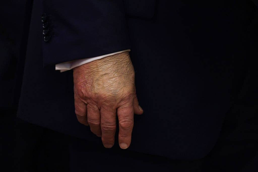 While Donald Trump enjoys a healthy medical report, his left hand suffered after striking a table