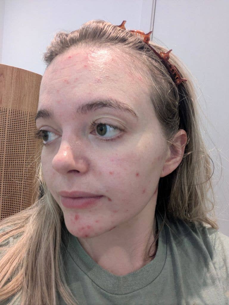 woman with spots on her face