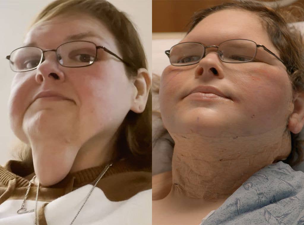 Tammy's before and after skin removals surgery